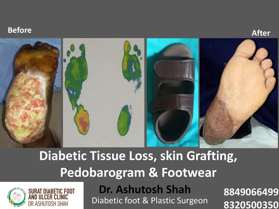 Investigations for Diabetic Foot.pptx-4.webp